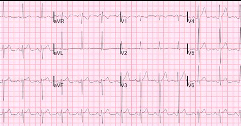 lvh with repolarization abnormality ecg